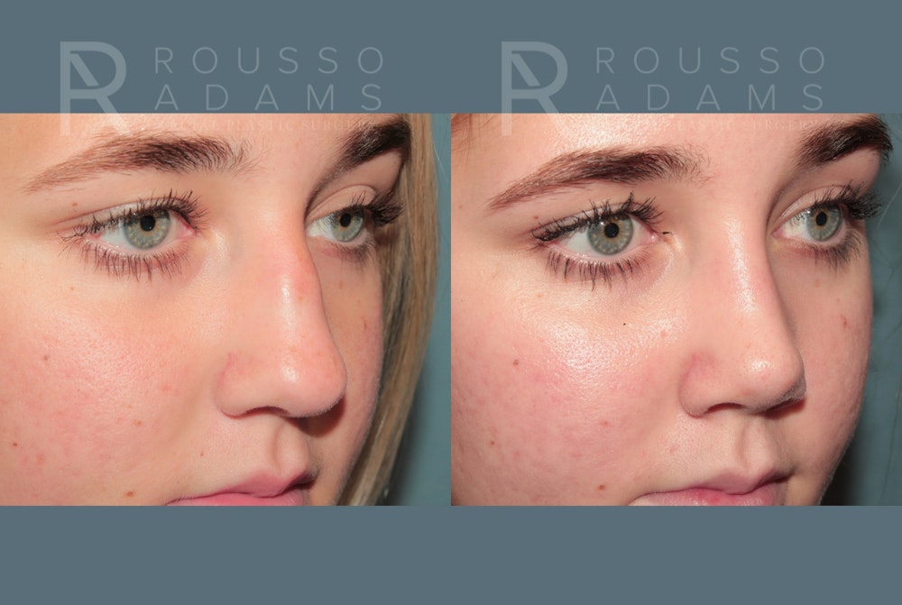 Rhinoplasty <span class=small>By Dr. Daniel Rousso</span> Before & After Gallery - Patient 332828 - Image 4