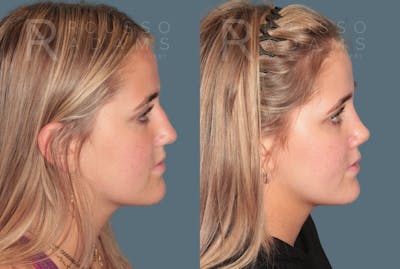 Rhinoplasty <span class=small>By Dr. Daniel Rousso</span> Before & After Gallery - Patient 332828 - Image 1