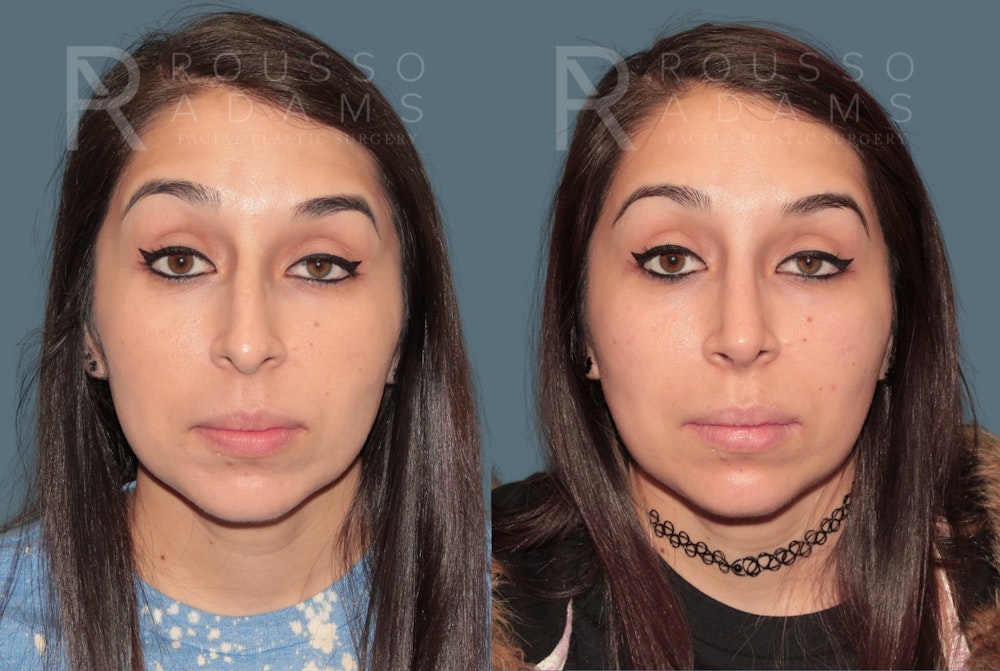 Rhinoplasty<span class=small>By Dr. Austin Adams</span> Before & After Gallery - Patient 109307 - Image 3