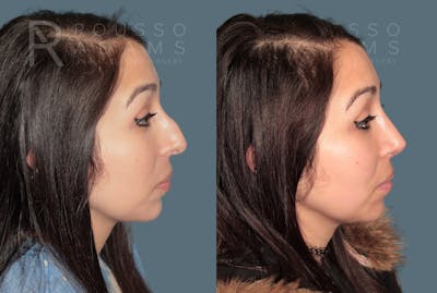 Rhinoplasty<span class=small>By Dr. Austin Adams</span> Before & After Gallery - Patient 109307 - Image 1