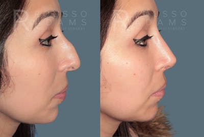 Rhinoplasty<span class=small>By Dr. Austin Adams</span> Before & After Gallery - Patient 109307 - Image 4