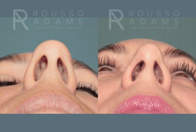 Rhinoplasty <span class=small>By Dr. Daniel Rousso</span> Before & After Gallery - Patient 116063 - Image 4