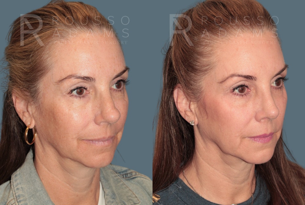 Rhinoplasty <span class=small>By Dr. Daniel Rousso</span> Before & After Gallery - Patient 116063 - Image 2