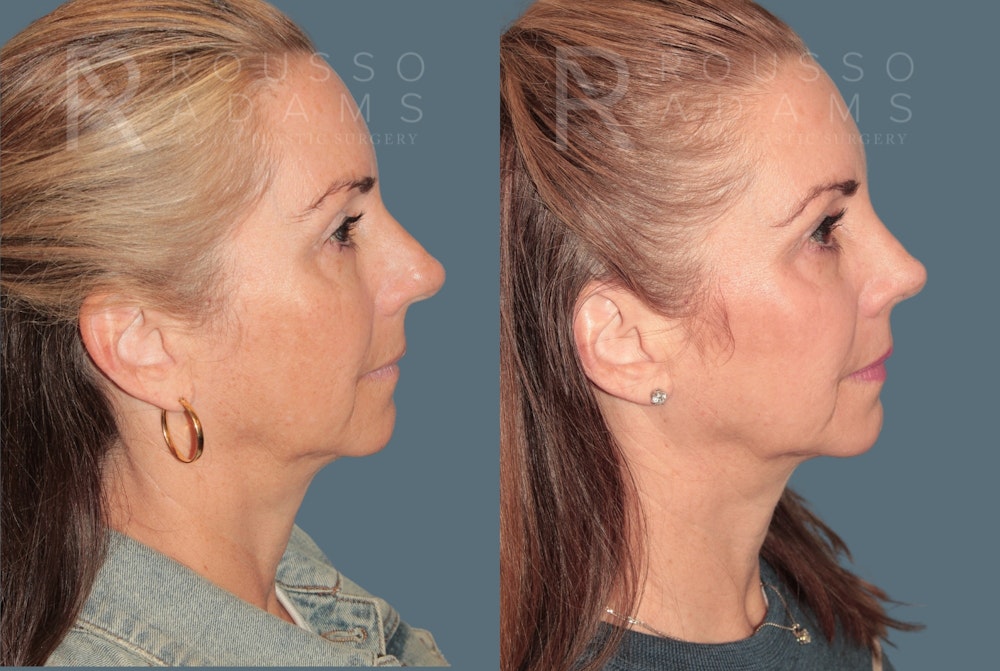 Rhinoplasty <span class=small>By Dr. Daniel Rousso</span> Before & After Gallery - Patient 116063 - Image 1