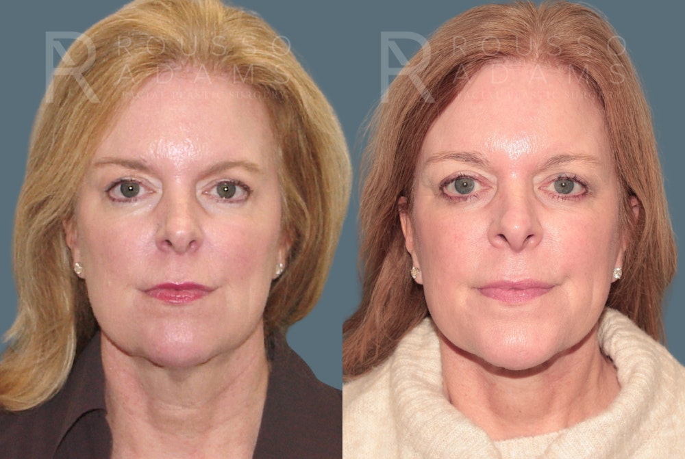 Facelift <span class=small>By Dr. Daniel Rousso</span> Before & After Gallery - Patient 170587 - Image 3