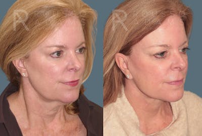 Facelift <span class=small>By Dr. Daniel Rousso</span> Before & After Gallery - Patient 170587 - Image 1