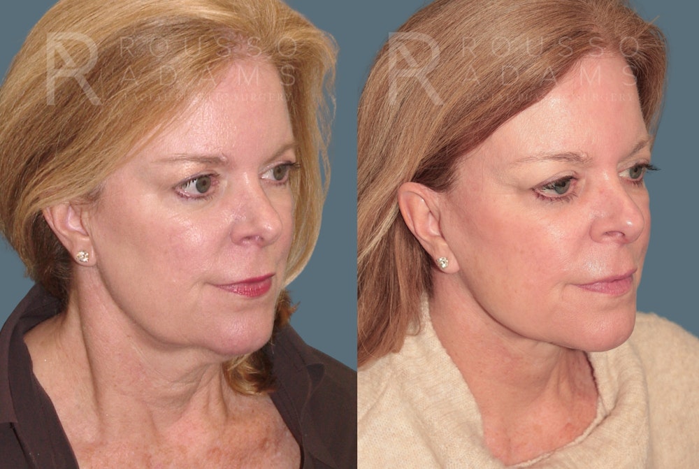 Facelift <span class=small>By Dr. Daniel Rousso</span> Before & After Gallery - Patient 170587 - Image 1
