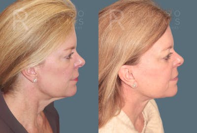 Facelift <span class=small>By Dr. Daniel Rousso</span> Before & After Gallery - Patient 170587 - Image 2