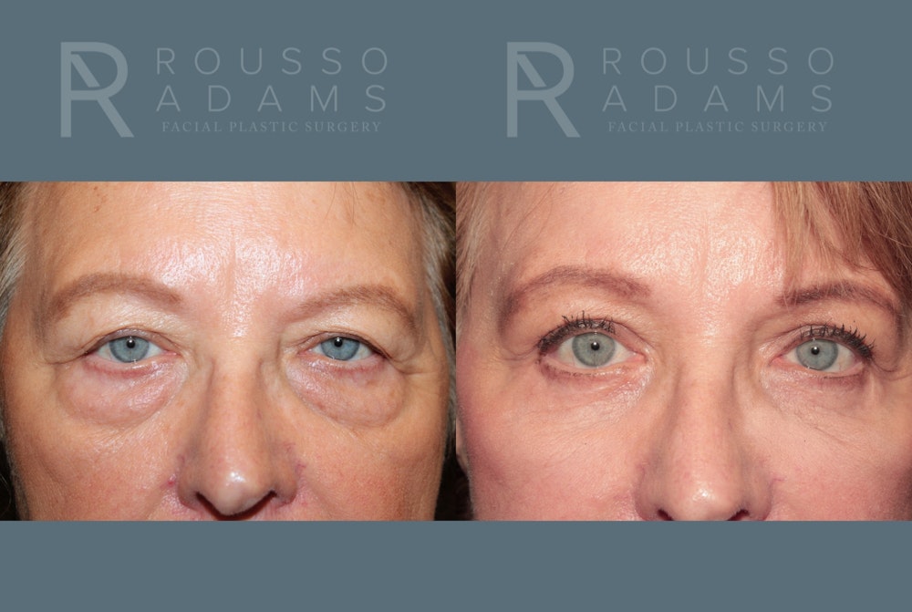 Deep Plane Facelift <span class=small>By Dr. Daniel Rousso</span> Before & After Gallery - Patient 271105 - Image 4
