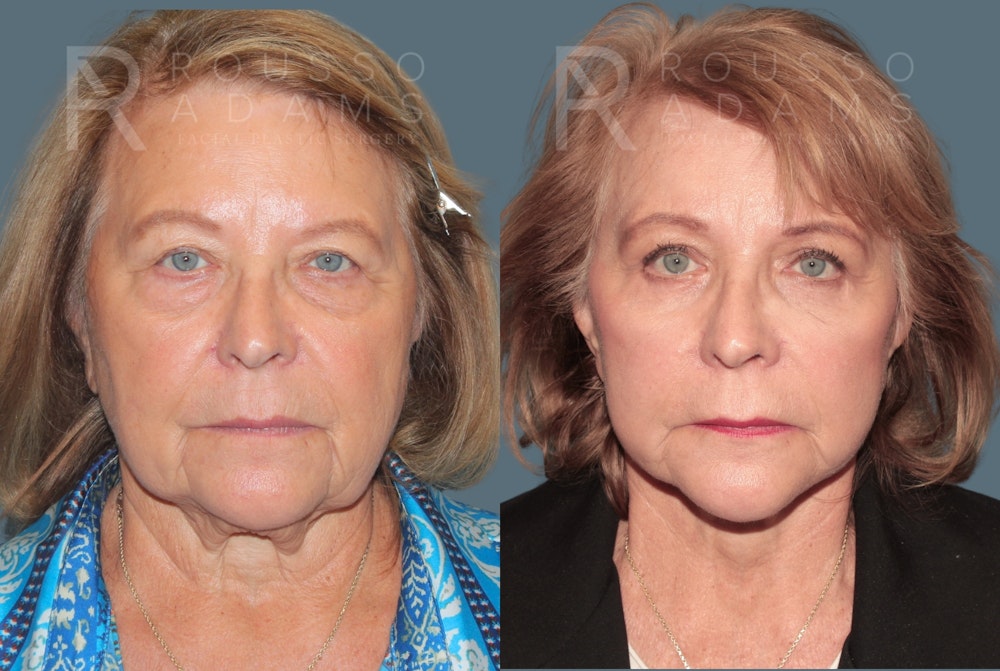 Deep Plane Facelift <span class=small>By Dr. Daniel Rousso</span> Before & After Gallery - Patient 271105 - Image 3