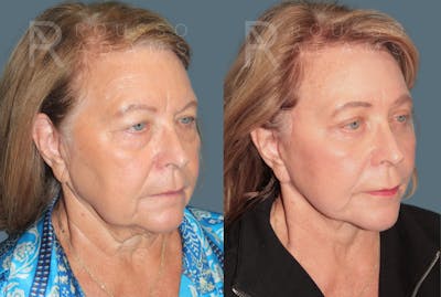 Deep Plane Facelift <span class=small>By Dr. Daniel Rousso</span> Before & After Gallery - Patient 271105 - Image 1