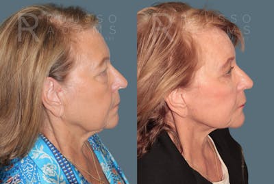 Deep Plane Facelift <span class=small>By Dr. Daniel Rousso</span> Before & After Gallery - Patient 271105 - Image 2