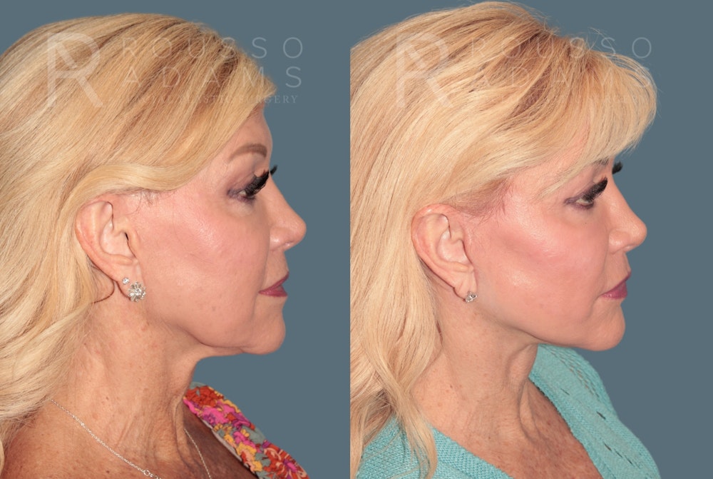 Deep Plane Facelift <span class=small>By Dr. Daniel Rousso</span> Before & After Gallery - Patient 436528 - Image 2