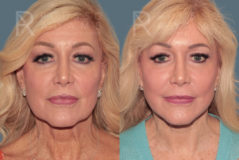 Deep Plane Facelift <span class=small>By Dr. Daniel Rousso</span> Before & After Gallery - Patient 436528 - Image 3