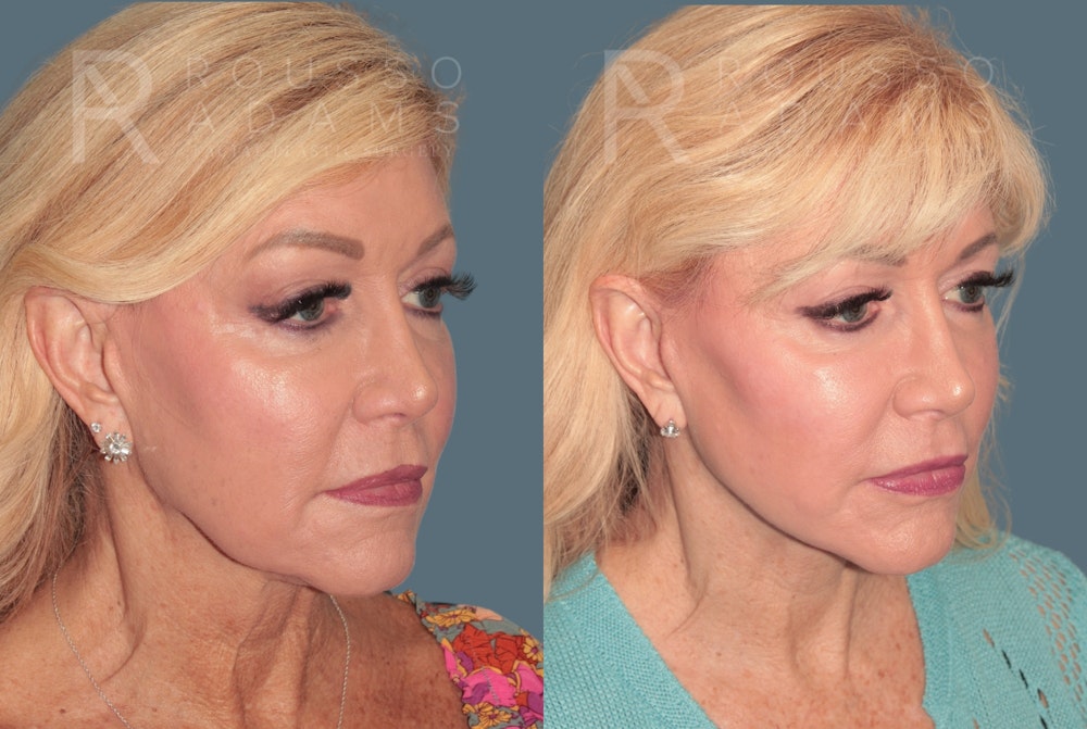 Deep Plane Facelift <span class=small>By Dr. Daniel Rousso</span> Before & After Gallery - Patient 436528 - Image 1