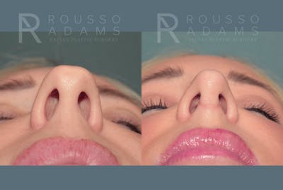 Rhinoplasty<span class=small>By Dr. Austin Adams</span> Before & After Gallery - Patient 287967 - Image 4