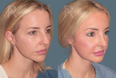 Rhinoplasty<span class=small>By Dr. Austin Adams</span> Before & After Gallery - Patient 287967 - Image 2