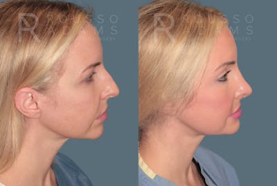 Rhinoplasty<span class=small>By Dr. Austin Adams</span> Before & After Gallery - Patient 287967 - Image 1