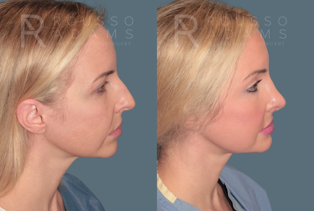 Rhinoplasty<span class=small>By Dr. Austin Adams</span> Before & After Gallery - Patient 287967 - Image 1