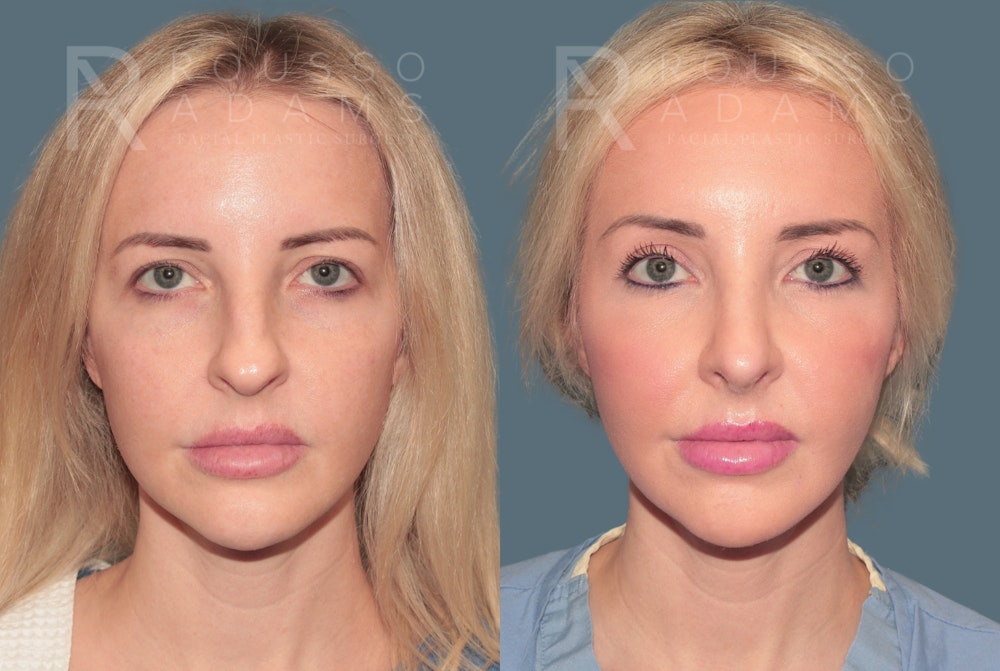 Rhinoplasty<span class=small>By Dr. Austin Adams</span> Before & After Gallery - Patient 287967 - Image 3