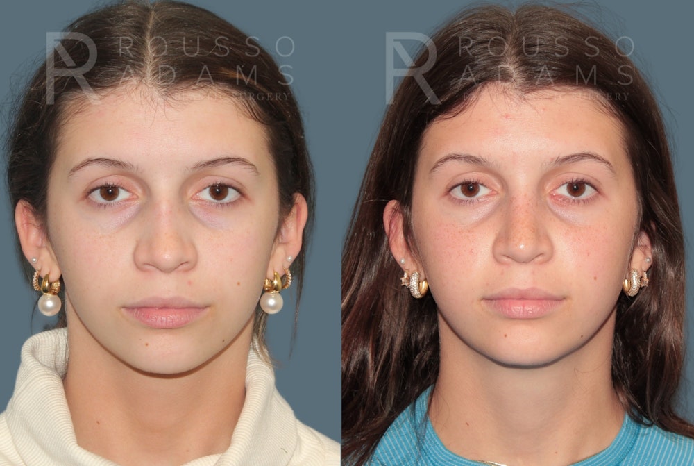 Rhinoplasty<span class=small>By Dr. Austin Adams</span> Before & After Gallery - Patient 324336 - Image 3