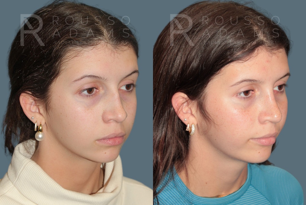 Rhinoplasty<span class=small>By Dr. Austin Adams</span> Before & After Gallery - Patient 324336 - Image 2