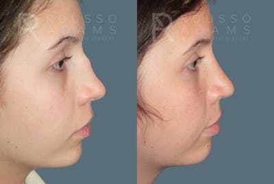 Rhinoplasty<span class=small>By Dr. Austin Adams</span> Before & After Gallery - Patient 324336 - Image 4