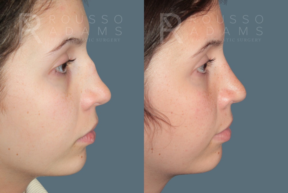 Rhinoplasty<span class=small>By Dr. Austin Adams</span> Before & After Gallery - Patient 324336 - Image 4