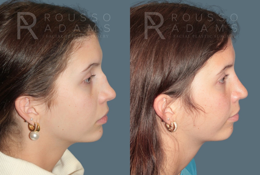 Rhinoplasty<span class=small>By Dr. Austin Adams</span> Before & After Gallery - Patient 324336 - Image 1