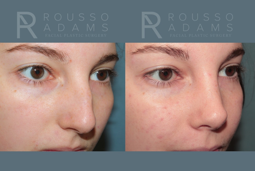 Rhinoplasty <span class=small>By Dr. Daniel Rousso</span> Before & After Gallery - Patient 222143 - Image 5
