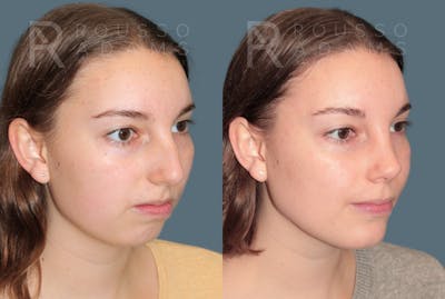Rhinoplasty <span class=small>By Dr. Daniel Rousso</span> Before & After Gallery - Patient 222143 - Image 2