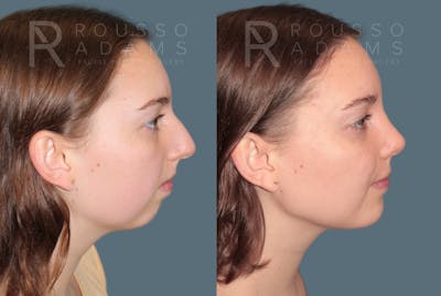 Rhinoplasty <span class=small>By Dr. Daniel Rousso</span> Before & After Gallery - Patient 222143 - Image 1