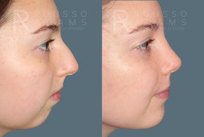Rhinoplasty <span class=small>By Dr. Daniel Rousso</span> Before & After Gallery - Patient 222143 - Image 4