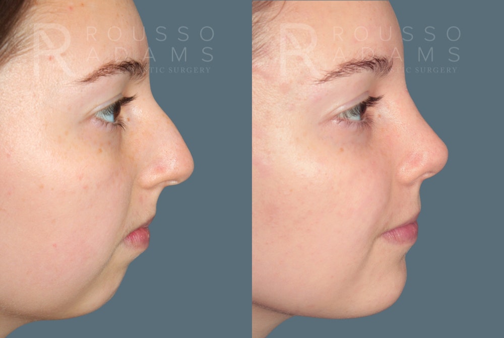 Rhinoplasty <span class=small>By Dr. Daniel Rousso</span> Before & After Gallery - Patient 222143 - Image 4