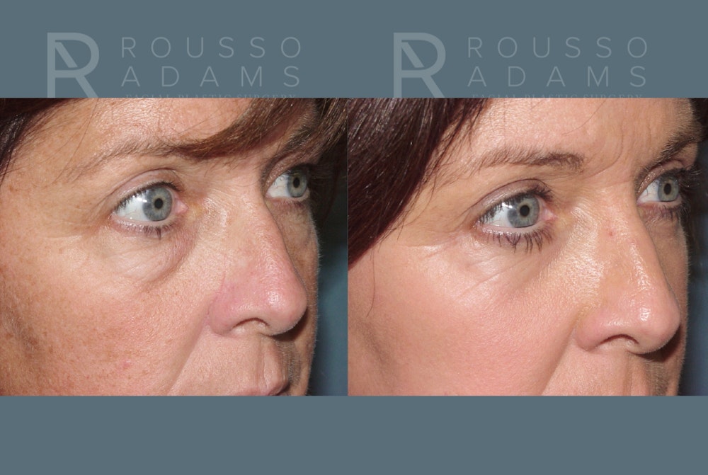 Skin Rejuvenation <span class=small>By Dr. Daniel Rousso</span> Before & After Gallery - Patient 422789 - Image 3