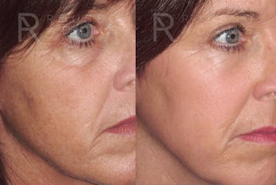 Skin Rejuvenation <span class=small>By Dr. Daniel Rousso</span> Before & After Gallery - Patient 422789 - Image 2