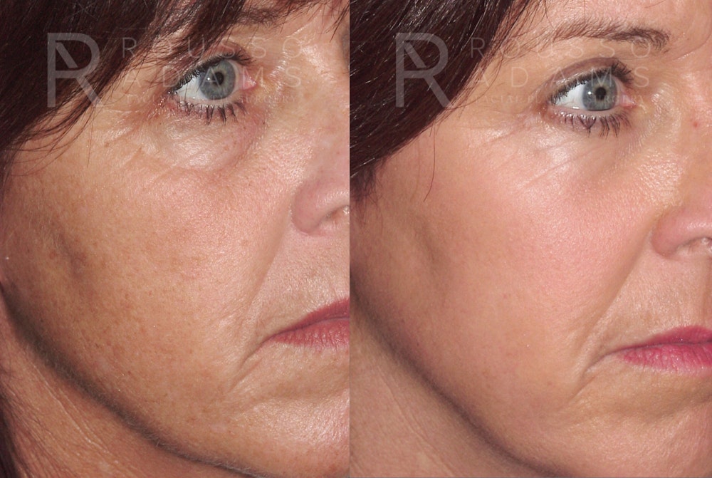Skin Rejuvenation <span class=small>By Dr. Daniel Rousso</span> Before & After Gallery - Patient 422789 - Image 2