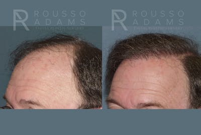 Hair Transplant Before & After Gallery - Patient 300035 - Image 1
