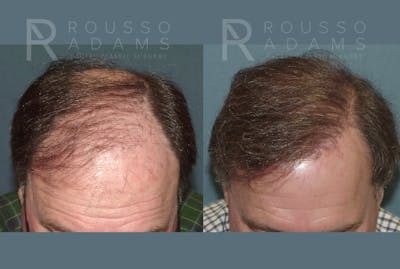 Hair Transplant Before & After Gallery - Patient 300035 - Image 2