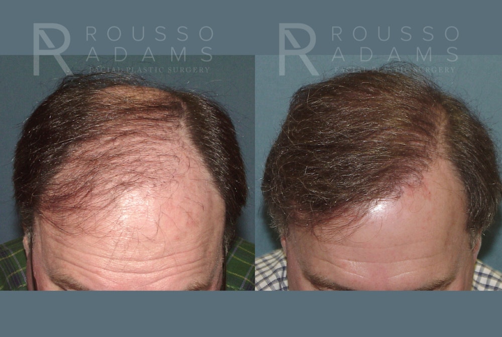 Hair Transplant Before & After Gallery - Patient 300035 - Image 2