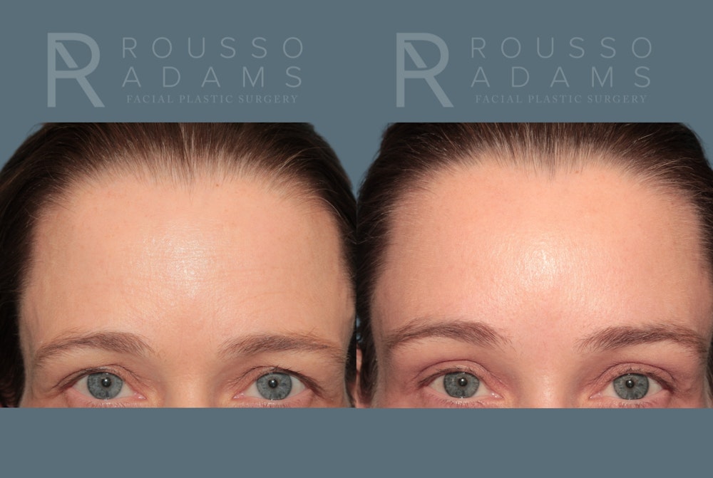Brow Lifts<span class=small>By Dr. Austin Adams</span> Before & After Gallery - Patient 147713 - Image 4