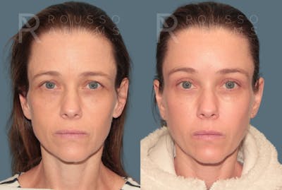 Brow Lifts<span class=small>By Dr. Austin Adams</span>  Before & After Gallery - Patient 147713 - Image 1