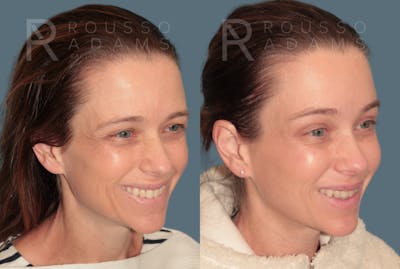 Brow Lifts<span class=small>By Dr. Austin Adams</span> Before & After Gallery - Patient 147713 - Image 2