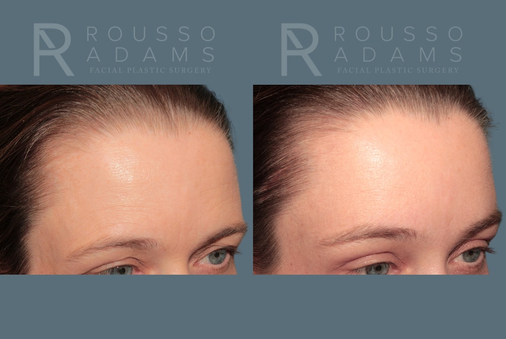 Brow Lifts<span class=small>By Dr. Austin Adams</span> Before & After Gallery - Patient 147713 - Image 5