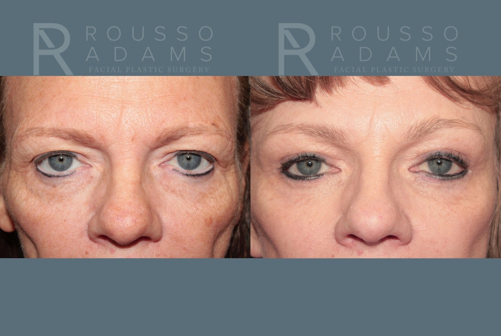 Deep Plane Facelift <span class=small>By Dr. Daniel Rousso</span> Before & After Gallery - Patient 337083 - Image 4