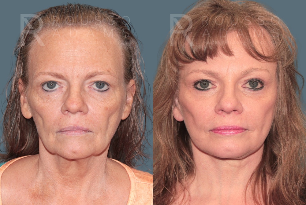 Deep Plane Facelift <span class=small>By Dr. Daniel Rousso</span> Before & After Gallery - Patient 337083 - Image 3