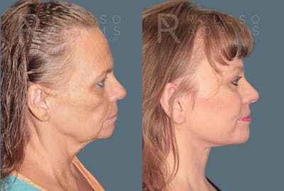Deep Plane Facelift <span class=small>By Dr. Daniel Rousso</span> Before & After Gallery - Patient 337083 - Image 2