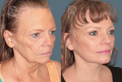 Deep Plane Facelift <span class=small>By Dr. Daniel Rousso</span> Before & After Gallery - Patient 337083 - Image 1