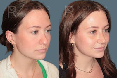 Rhinoplasty<span class=small>By Dr. Austin Adams</span> Before & After Gallery - Patient 331336 - Image 2