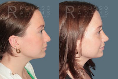 Rhinoplasty<span class=small>By Dr. Austin Adams</span> Before & After Gallery - Patient 331336 - Image 1